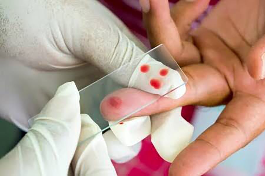 El Paludismo (O Malaria) Enfermedad Potencialmente Letal