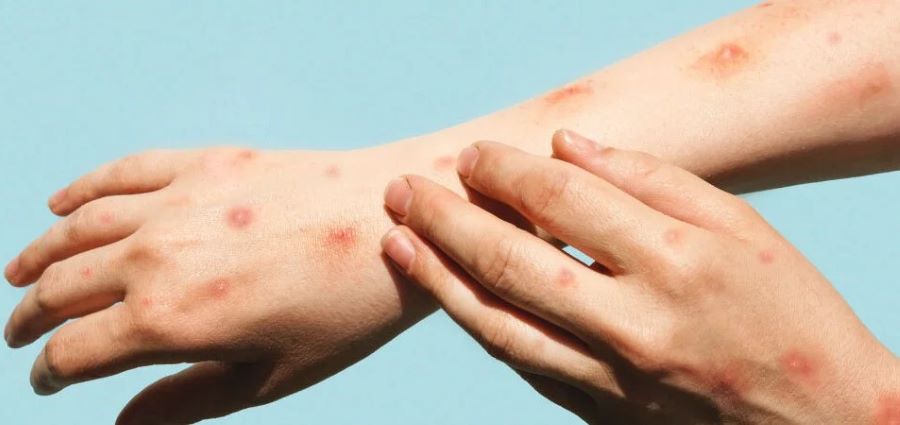 Nueva Variante de La Viruela del Mono ó Símica (Mpox)